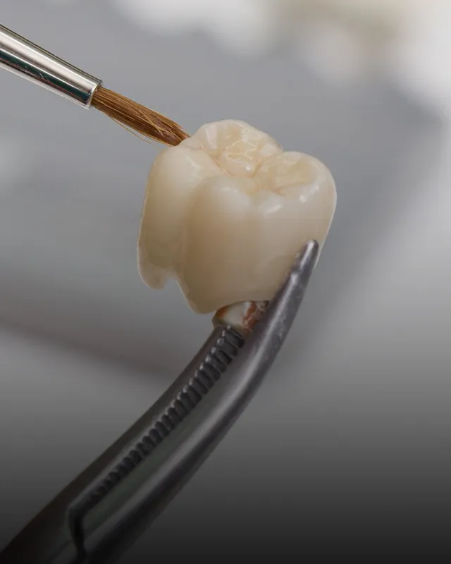 A dental crown being painted
