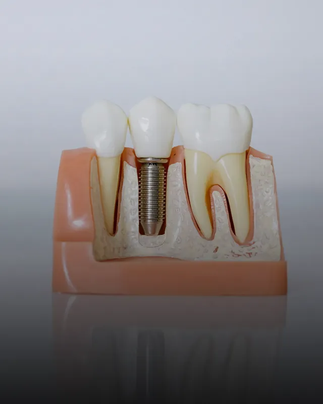 A dental model with an implant between two teeth